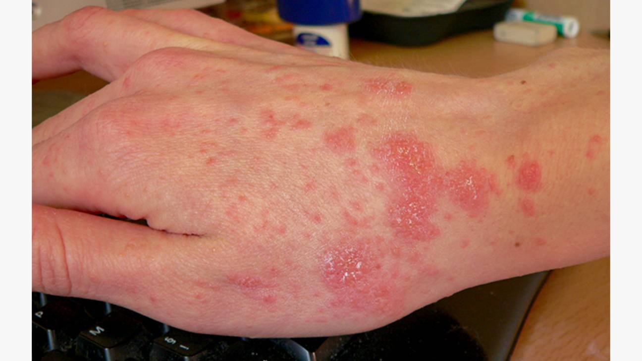 Scabies-on-the-hand-body1