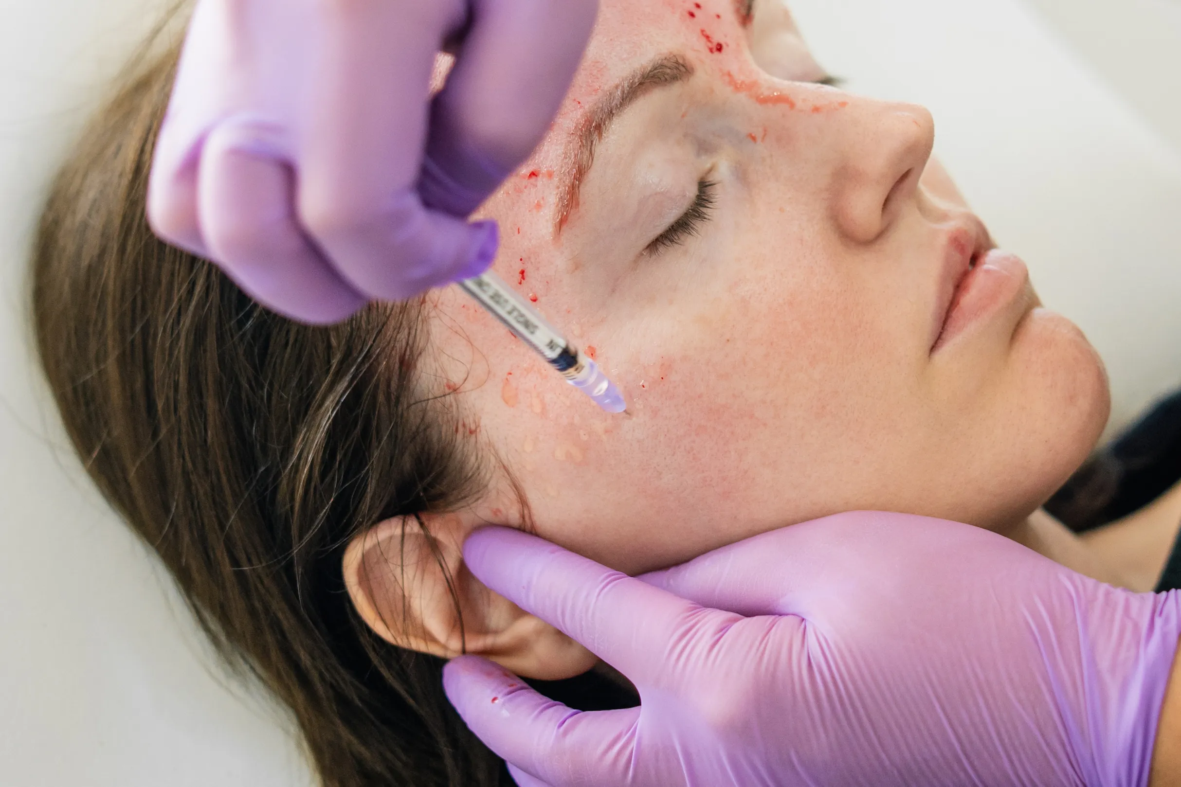 woman getting prp vampire facial done